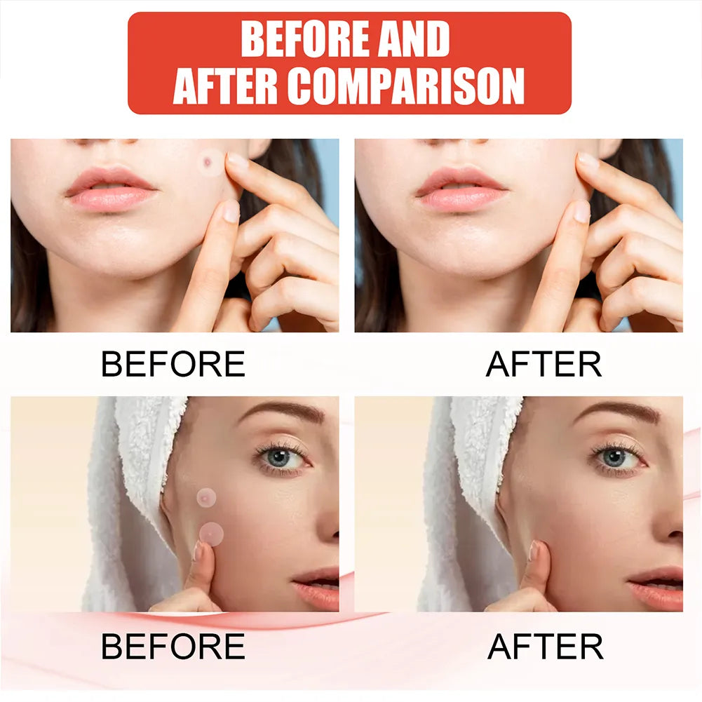 Pimple Patch |Invisible Acne Pimple Patch Stickers