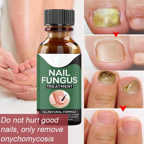 Fast Nail Fungal Repair Essences Serum Care Foot Nail Fungus Removal