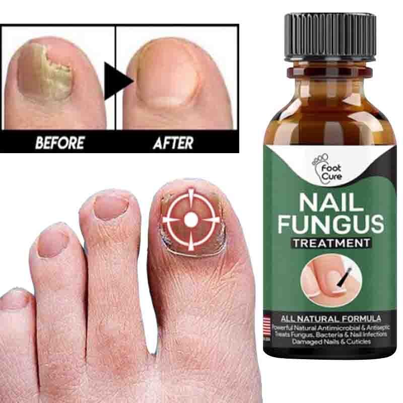 Fast Nail Fungal Repair Essences Serum Care Foot Nail Fungus Removal
