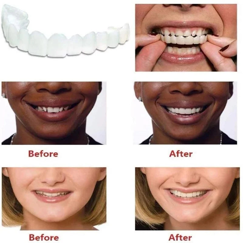 Instant Smile Reusable Snap On Veneers (Upper & Lower) Premium Quality
